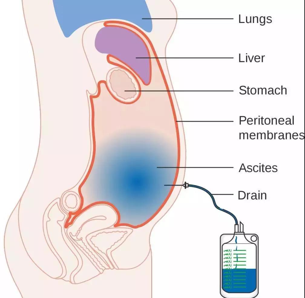 腹腔穿刺放液