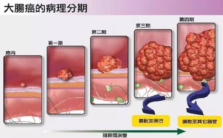 肠癌的临床表现是什么?