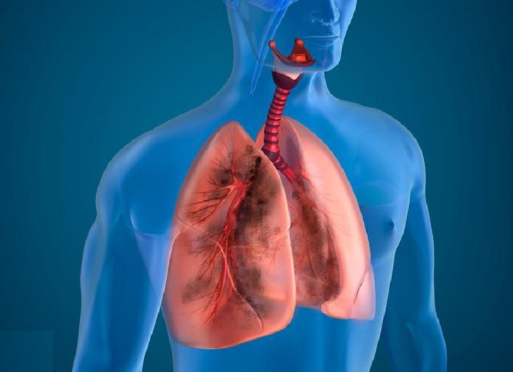 肺腺癌是什么病什么是肺腺癌早期肺腺癌早期症状有哪些