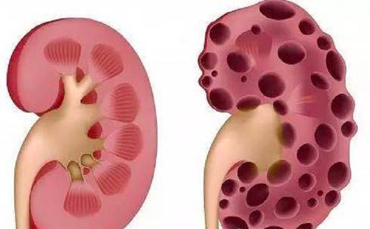 成人型多囊肾多为双侧性多发性囊肿,常有家族史,为先天遗传性肾脏