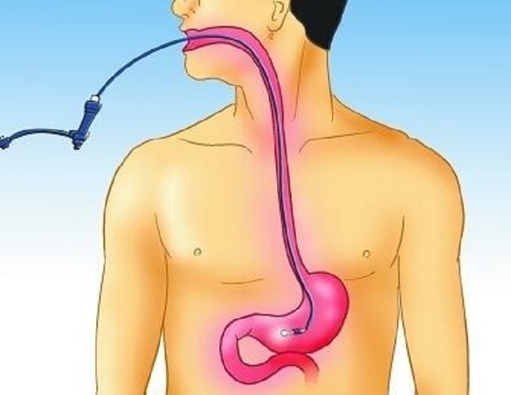1,病人检查不痛苦 传统胃镜需要把管子插入病人的消化道,让病人很