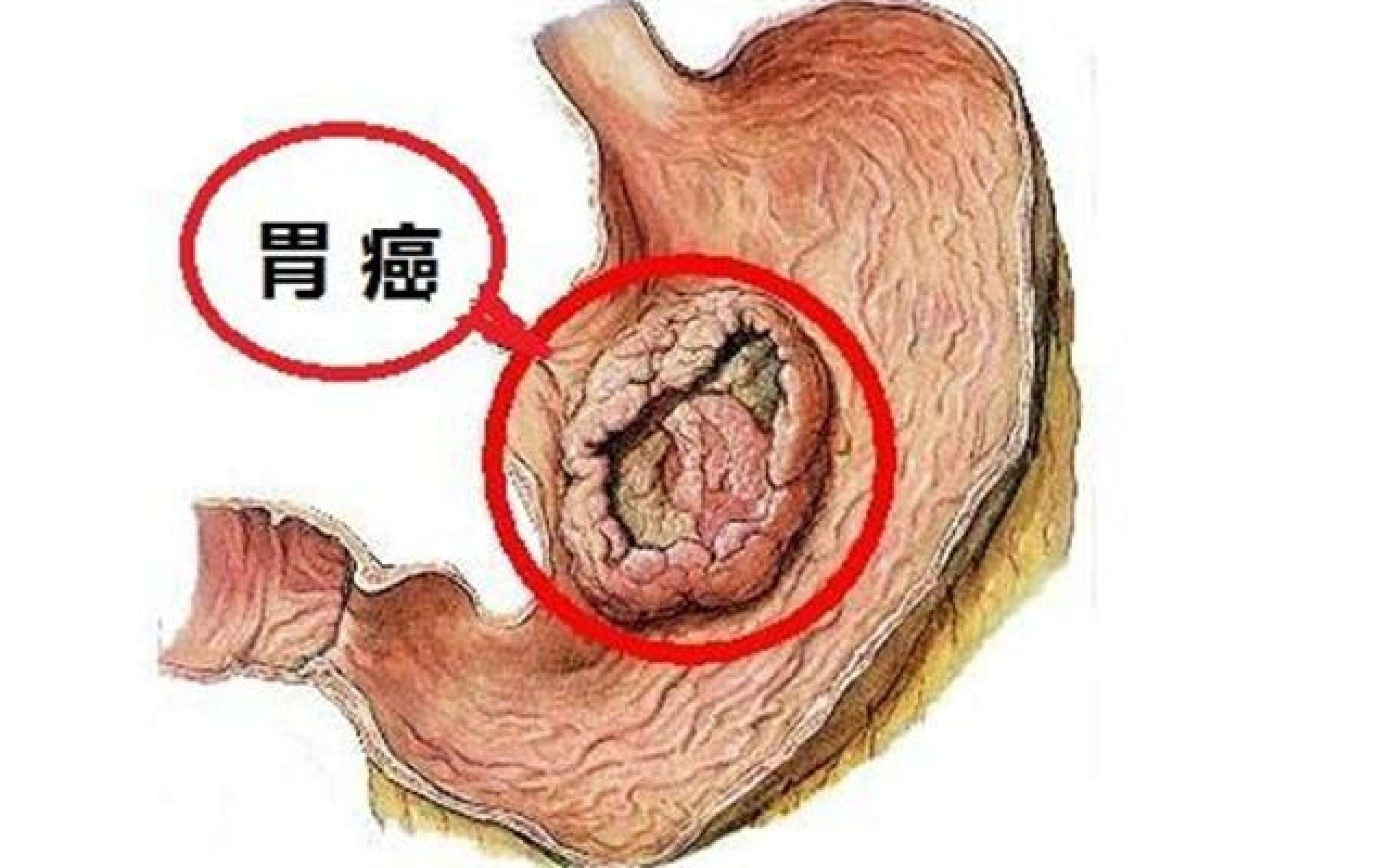 中国上胃癌发生率显著上升 专家这些中肯倡导40岁以人群应当看一看……