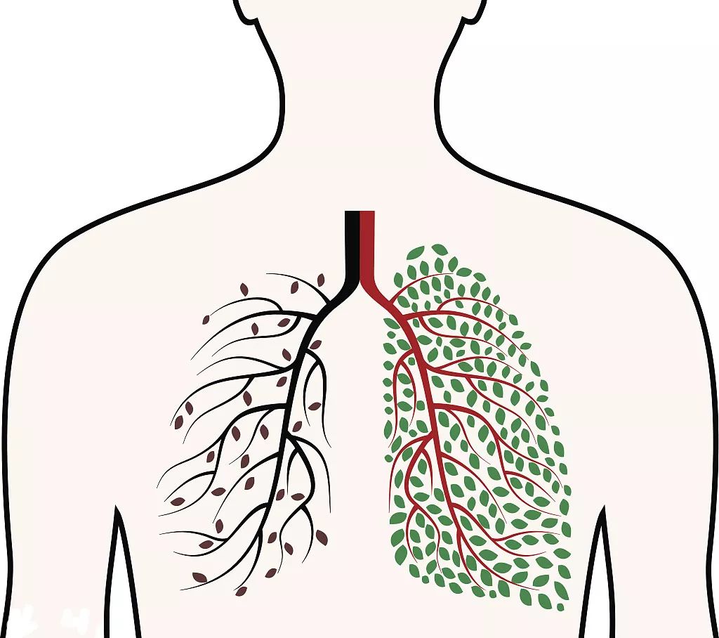 肺癌诊治的14大常见误区，警惕！