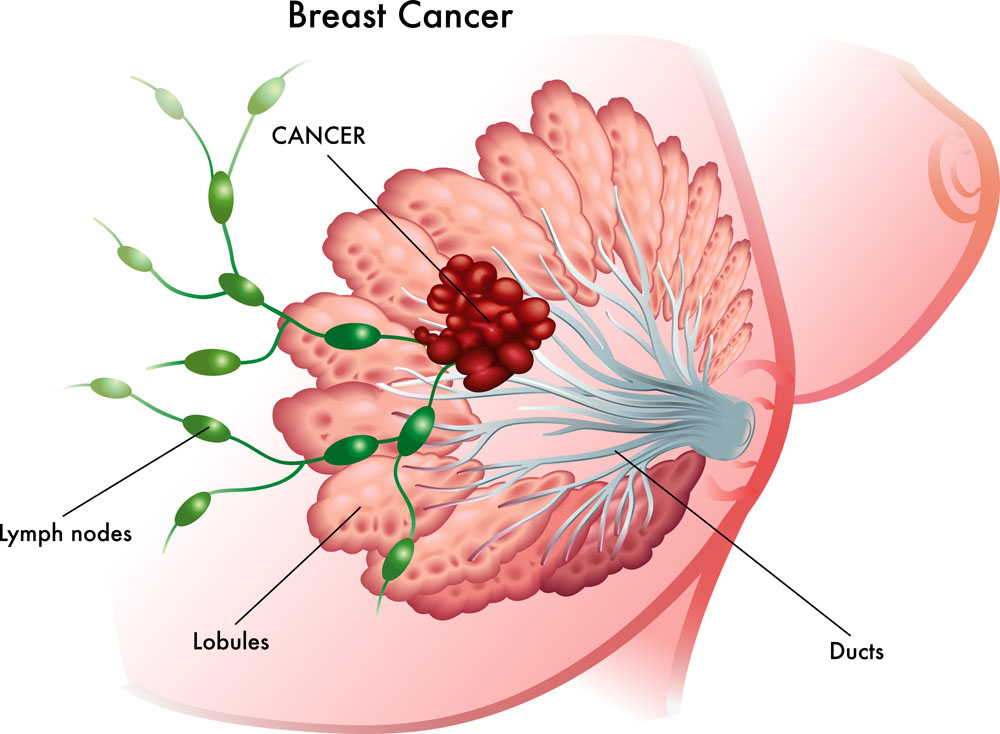 三阴性乳腺癌精准治疗中的三大问题