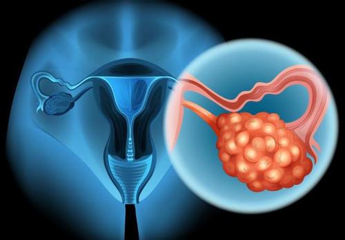 卵巢癌综述，卵巢癌病因是什么？临床表现有哪些？如何检查、治疗、护理及预防？
