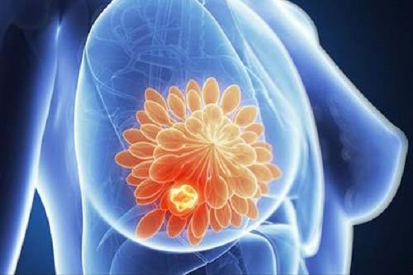 乳腺癌应当如何确诊？
