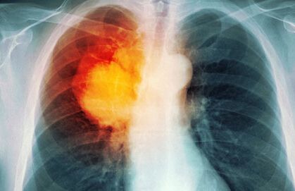 肺癌晚期，是选择治疗还是放弃？