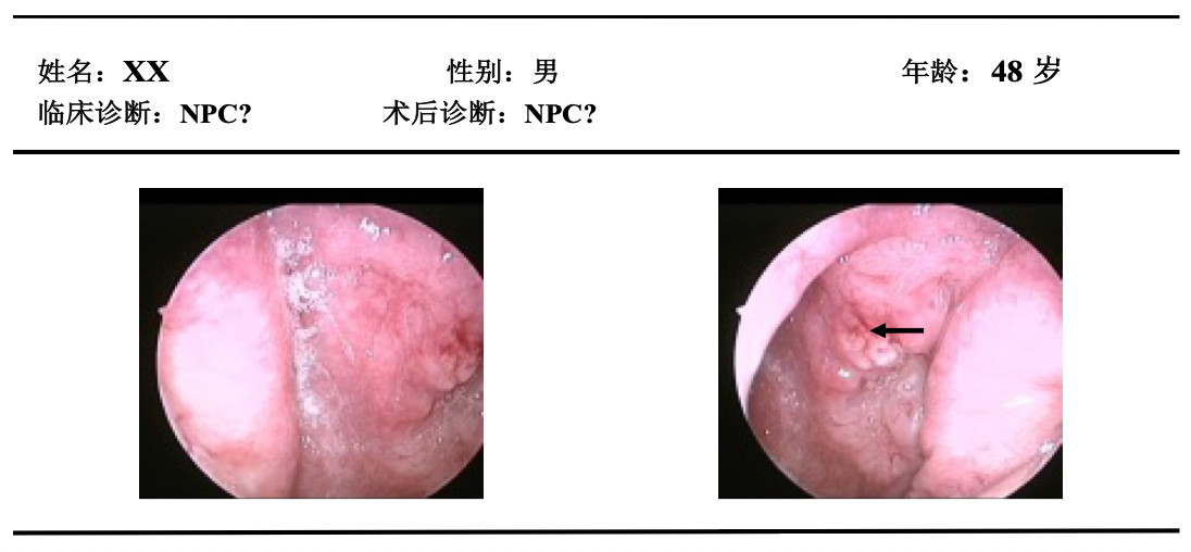 鼻咽癌筛查，应当如何做？