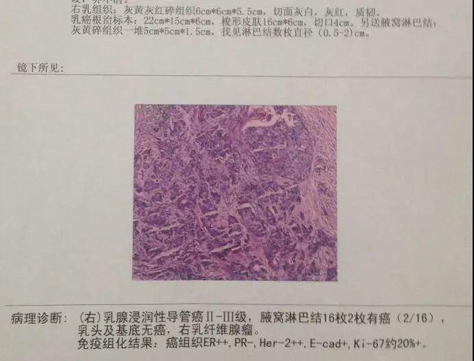 乳腺癌病理报告怎么看 如何解读