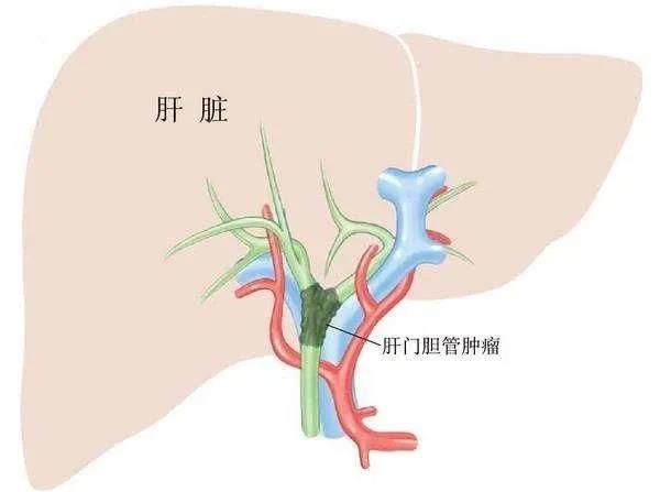 【胆管癌l022】icp-192治疗晚期胆道恶性肿瘤iia期临床试验