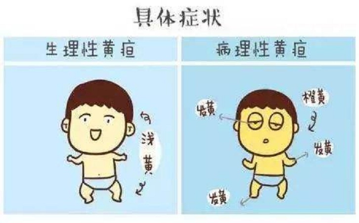 黄疸又称黄胆,俗称黄病,是一种由于血清中胆红素升高致使皮肤,黏膜和