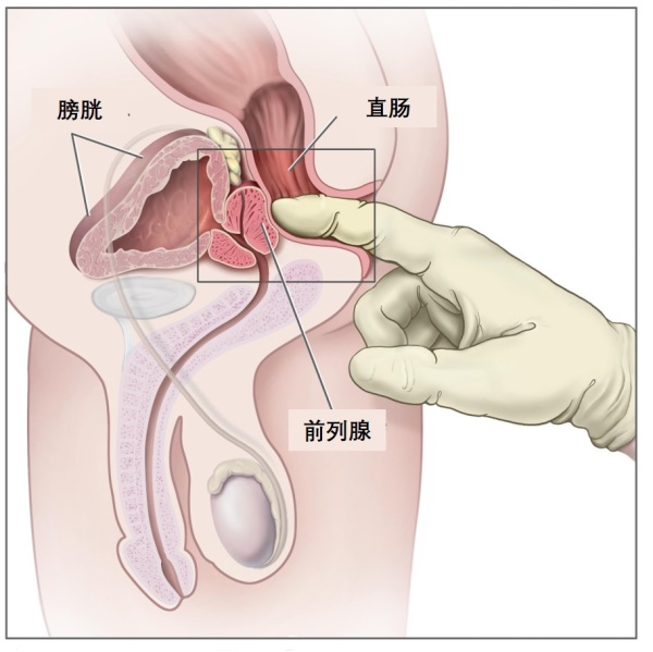 前列腺早期有什麼癥狀
