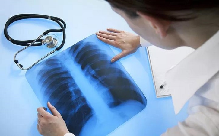 肺癌早期能活多久？